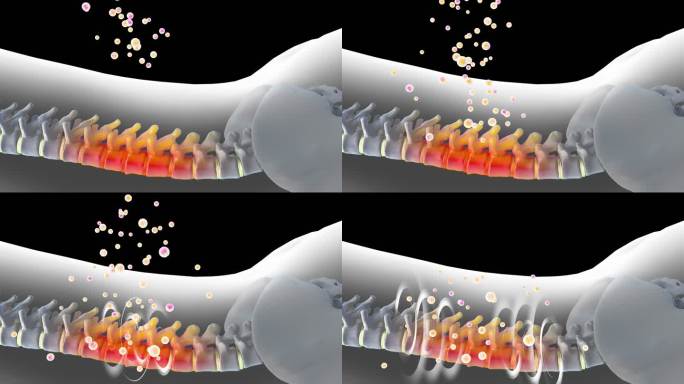 药物渗透腰椎恢复正常