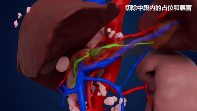 胰腺中断切除缝合手术三维动画