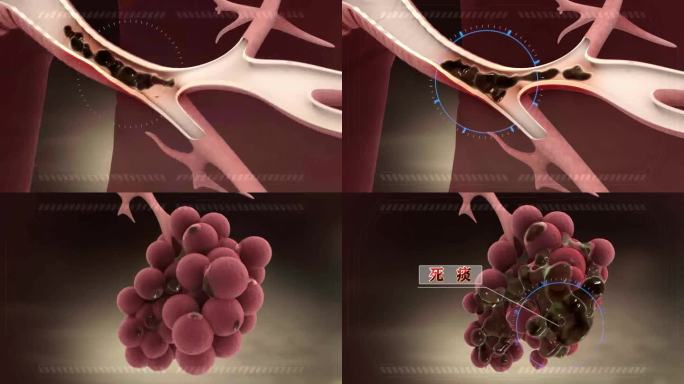 04死痰的形成过程