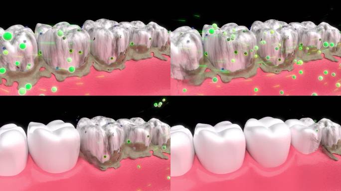 牙齿清洁去除牙菌斑带通道