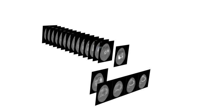 骨骼扫描修复3D打印视频素材