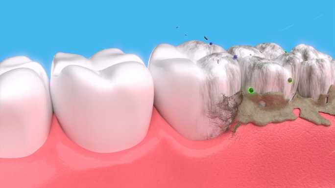 牙齿清洁去除牙菌斑