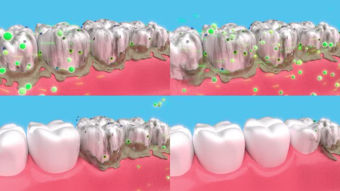 牙齿清洁去除牙菌斑