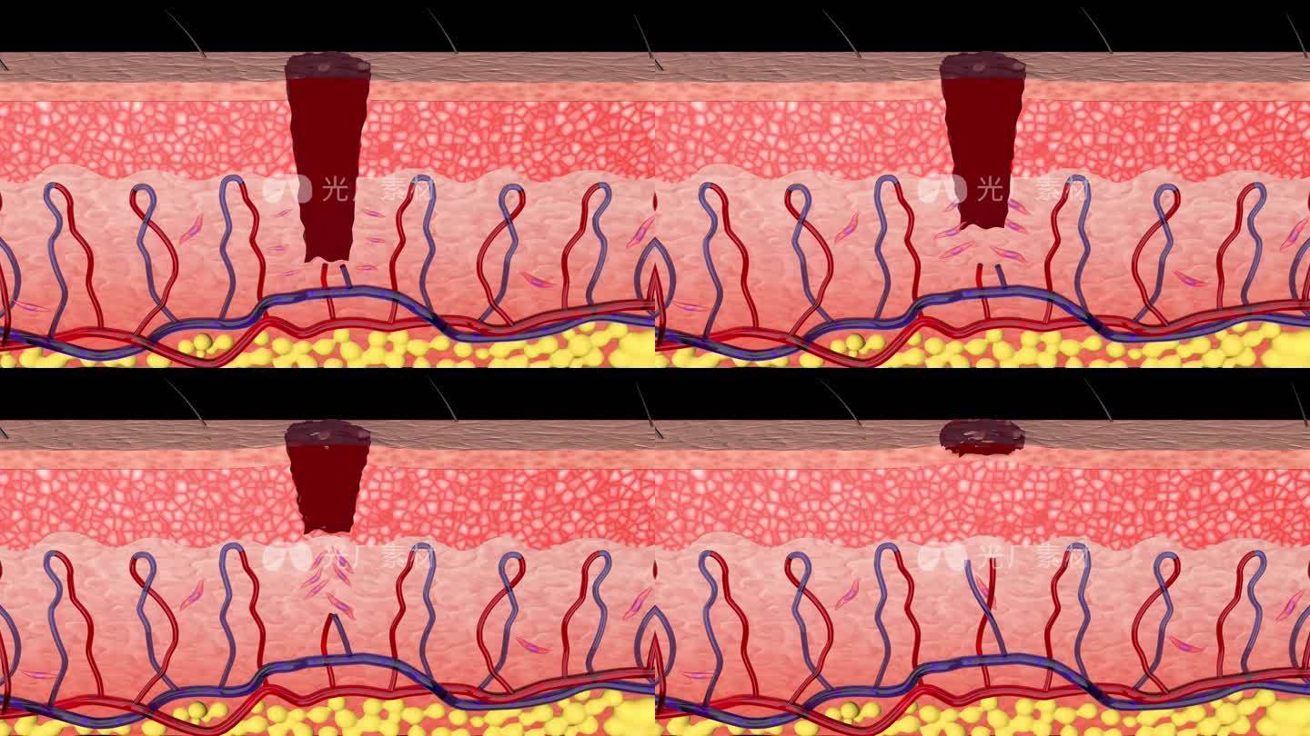 皮肤结构伤口愈合