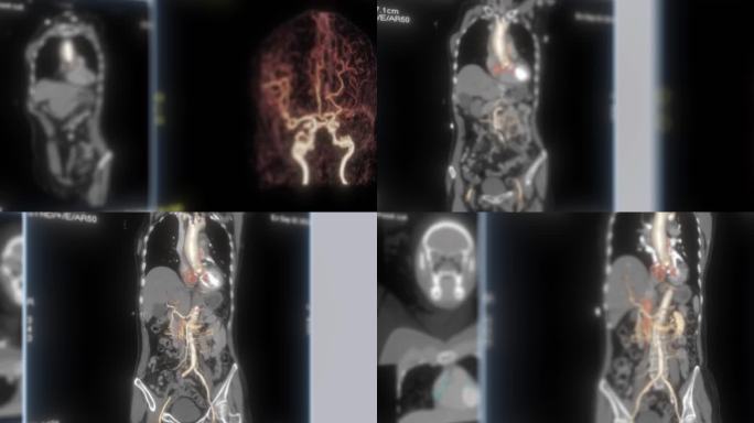 MRI影像 CT影像 动脉血管影像