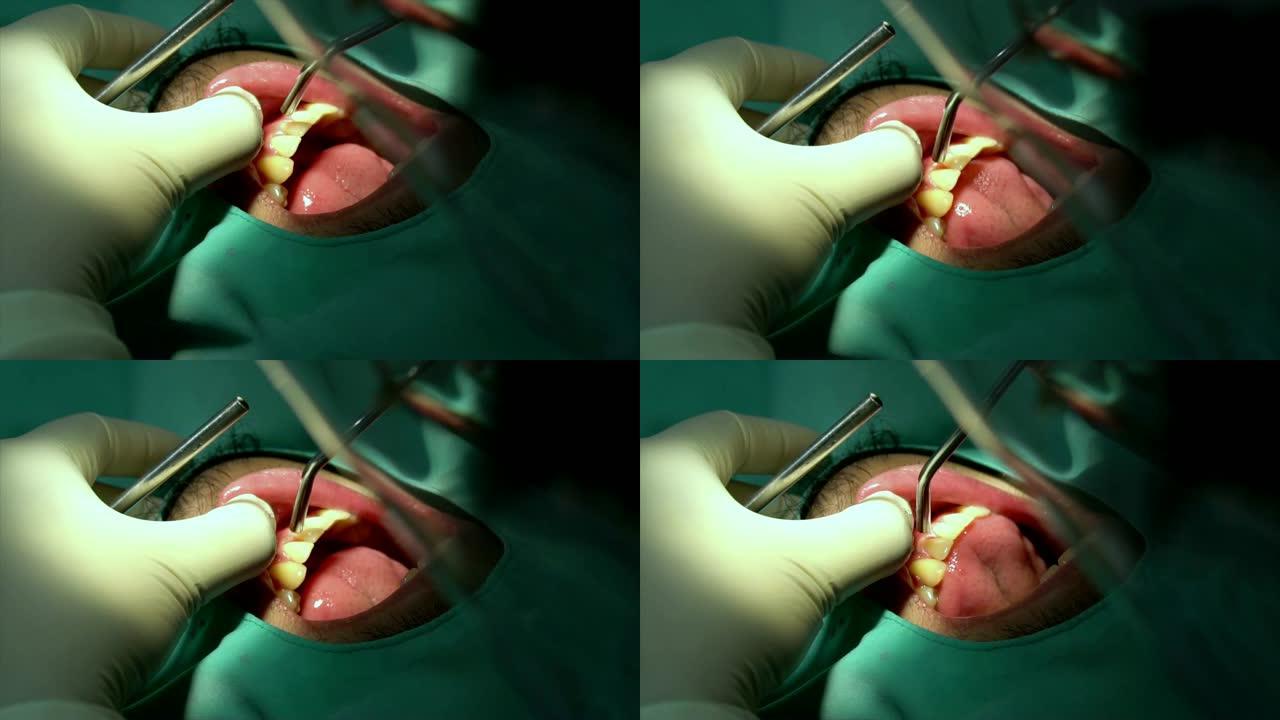 牙科诊所的牙医检查和牙齿清洁和抛光男性患者的4k慢动作镜头特写，牙齿护理和牙齿检查概念