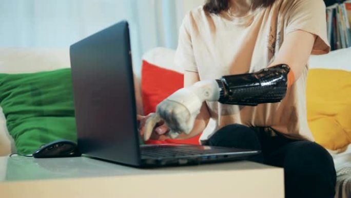 一位女士用仿生手在笔记本电脑上打字