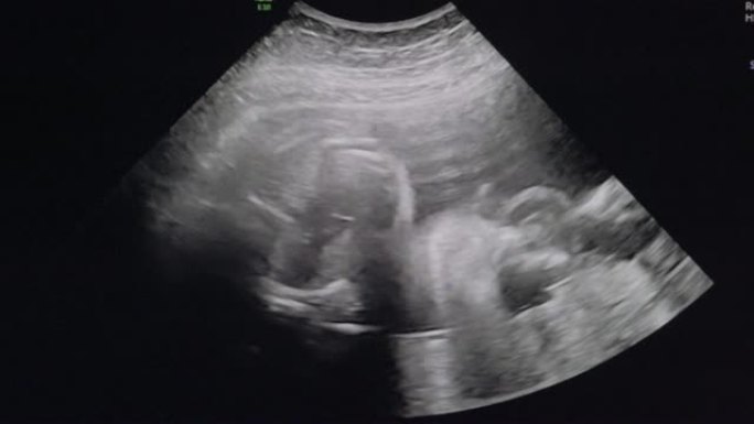 23周时胎儿的超声检查