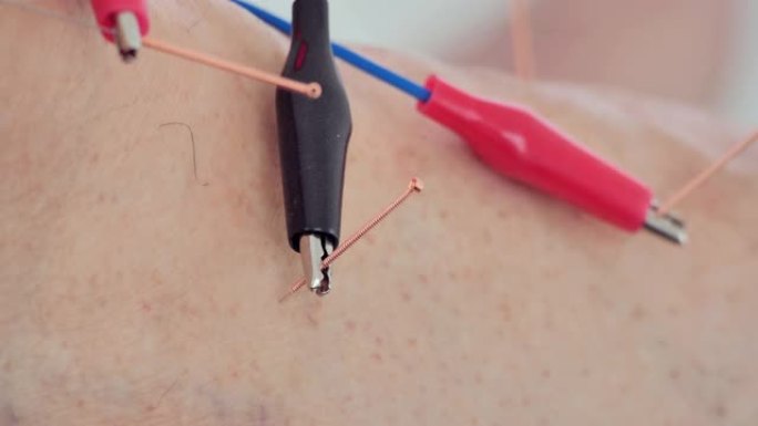 特写，理疗师正在病人的诊所用电刺激器对皮肤进行针灸。