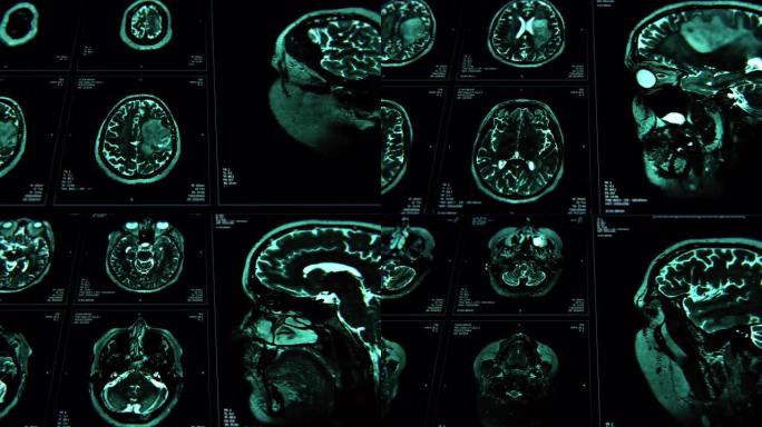 脑部MRI扫描。医治诊治治疗