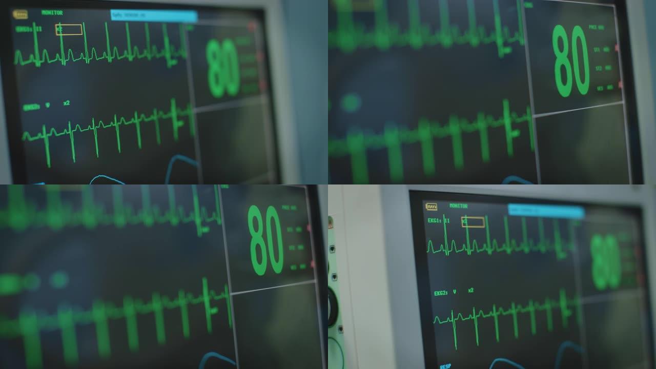 医院监测系统中的脉搏痕迹