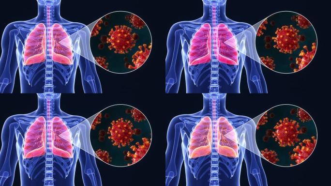 新型冠状病毒感染肺部三维动画