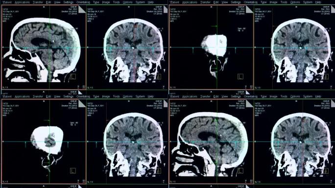 显示器上显示的大脑扫描过程