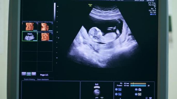 带有胎儿超声图像的计算机屏幕