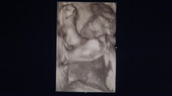23周时胎儿的超声检查