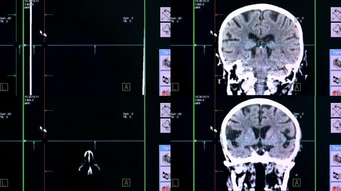 在扫描过程中显示脑部病例的特写