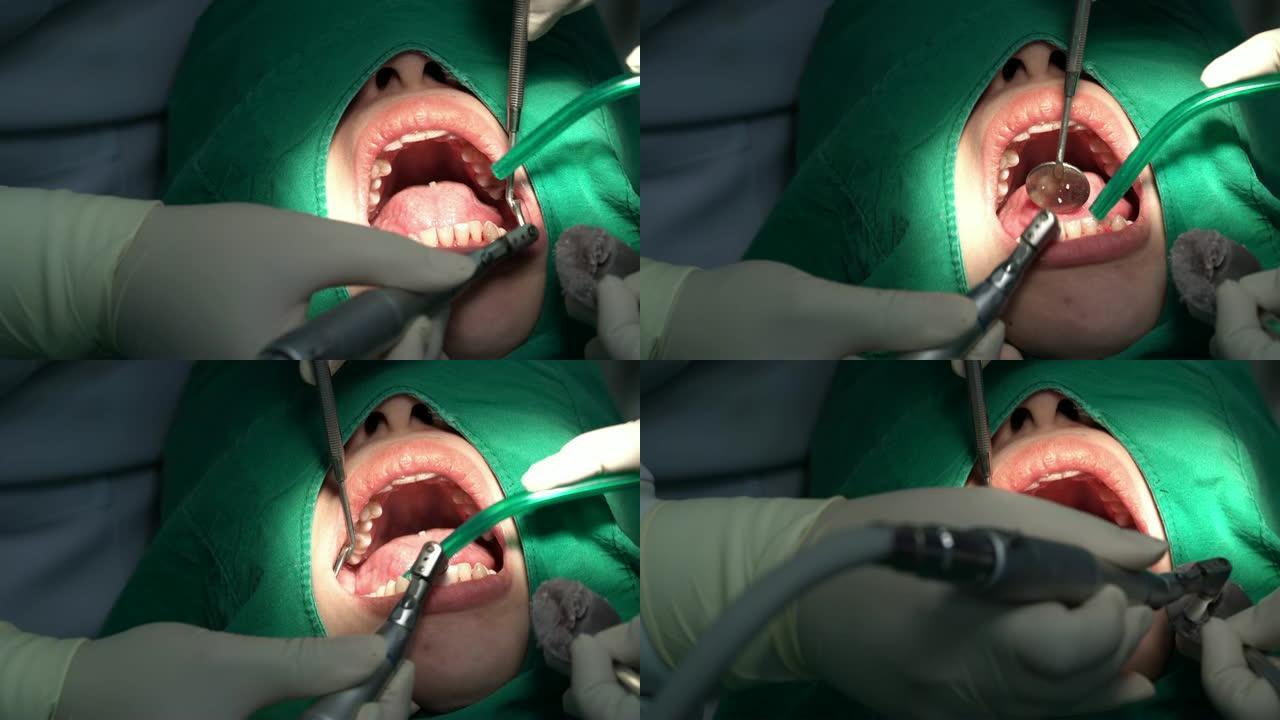 4k镜头场景牙医和助理的特写镜头为牙科诊所的女性患者操作氟化物涂层和牙齿清洁和抛光，牙齿护理和牙齿检