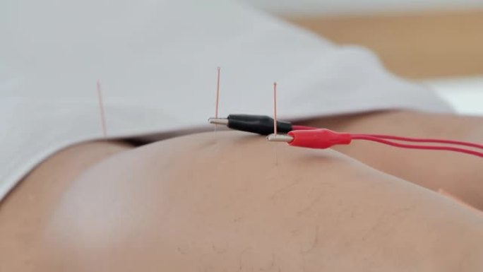 特写，物理治疗师正在病人的诊所用电刺激器对皮肤进行针灸。替代医学概念。