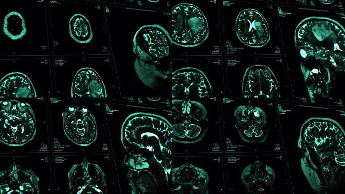脑部MRI扫描。蓝色。医学背景。头部x光。千克。