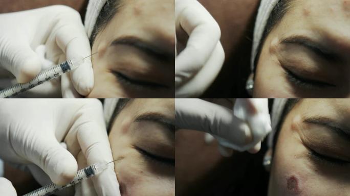 医生双手戴着白手套，在亚洲女性皮肤上进行面部老化注射 ..填充剂注射。