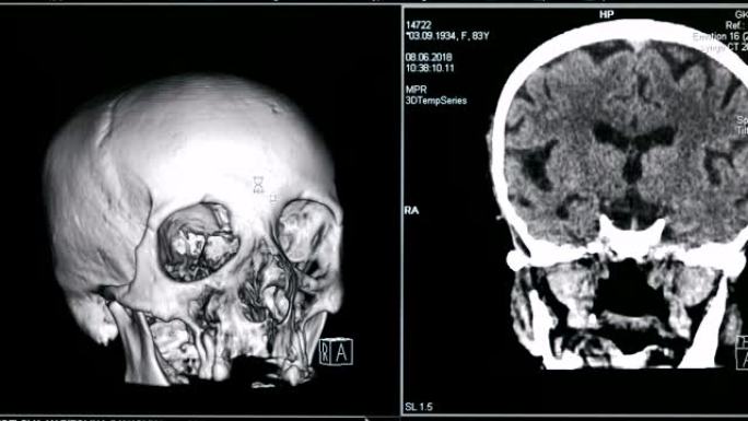 筛查监视器上显示的人脑病例的3D模型