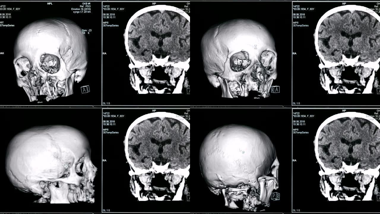 筛查监视器上显示的人脑病例的3D模型