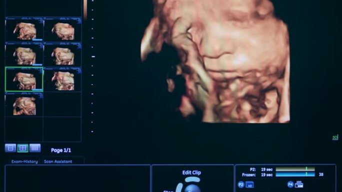 未出生婴儿的3D超声图像