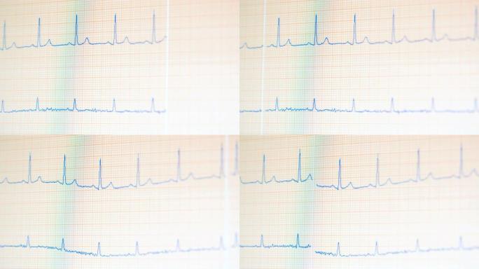 心电监护仪显示健康的心跳。