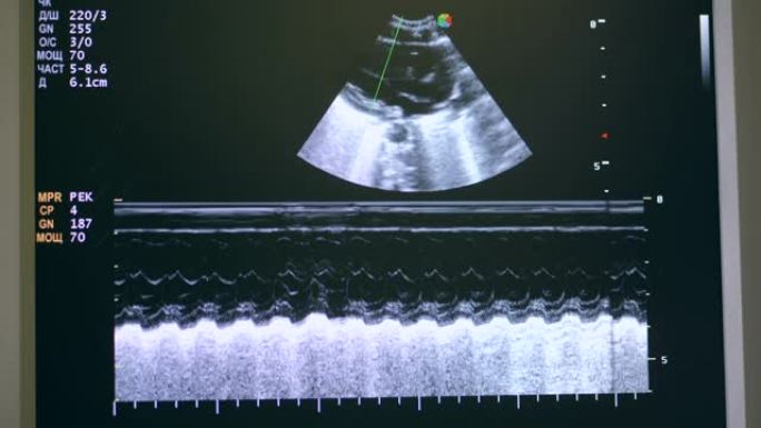 工作中的超声机构的屏幕