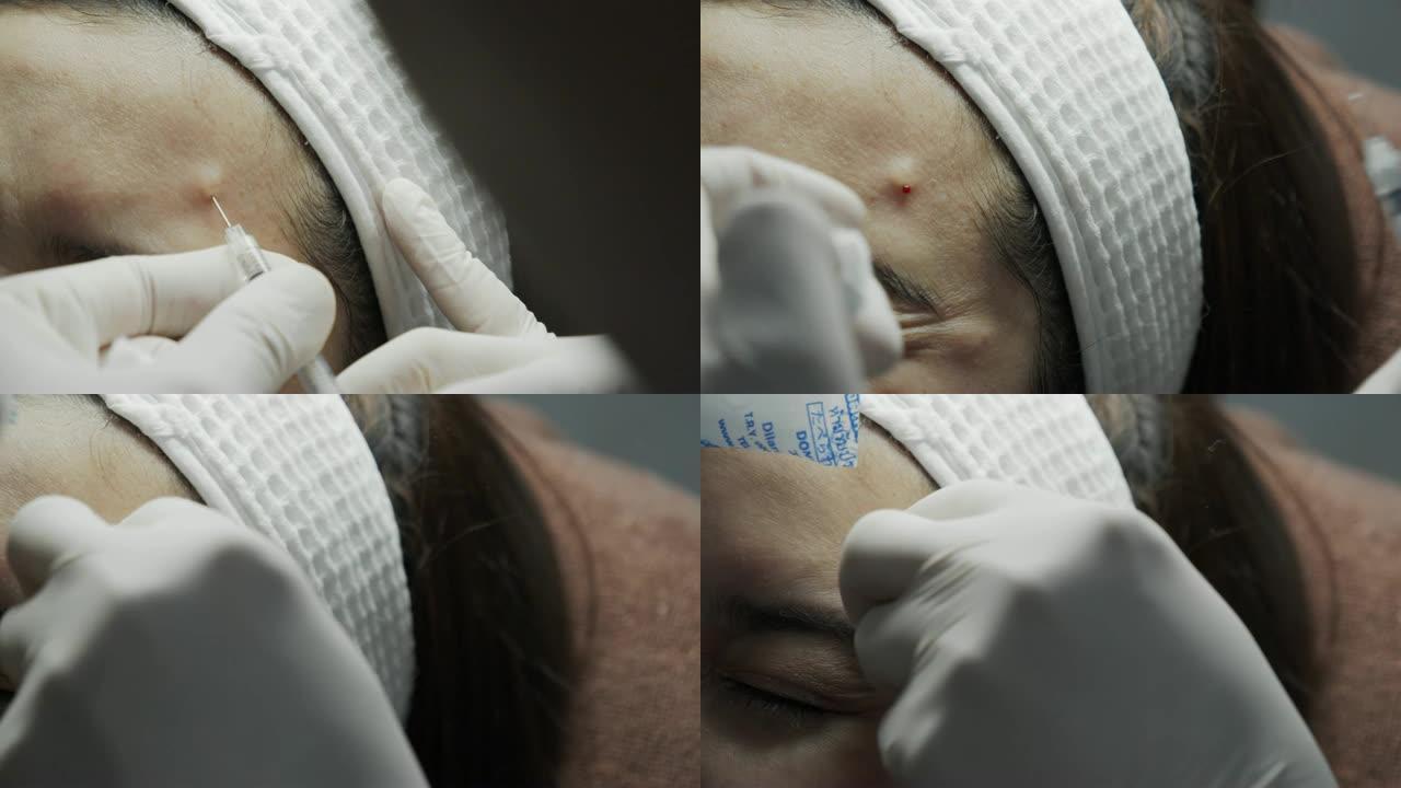 医生双手戴着白手套，在亚洲女性皮肤上进行面部老化注射 ..填充剂注射。