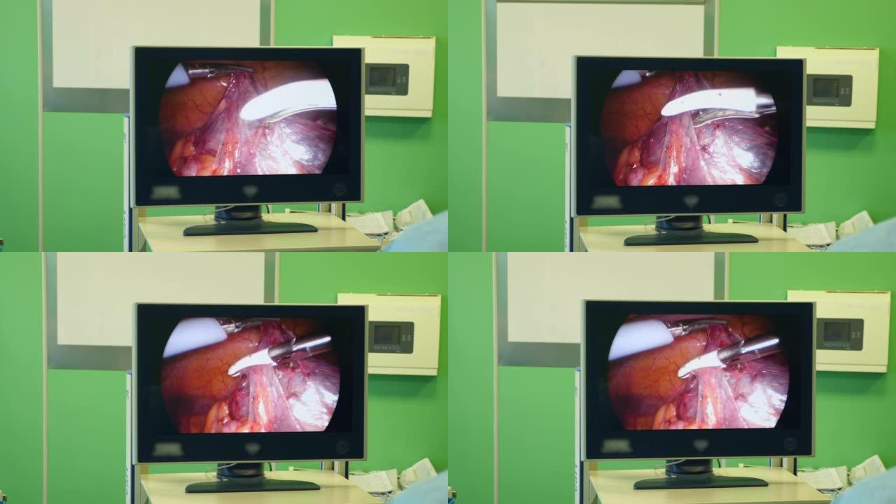 手术过程正在展示做手术动手术视频素材