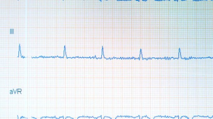 心电图图形。心电监护仪显示健康的心跳