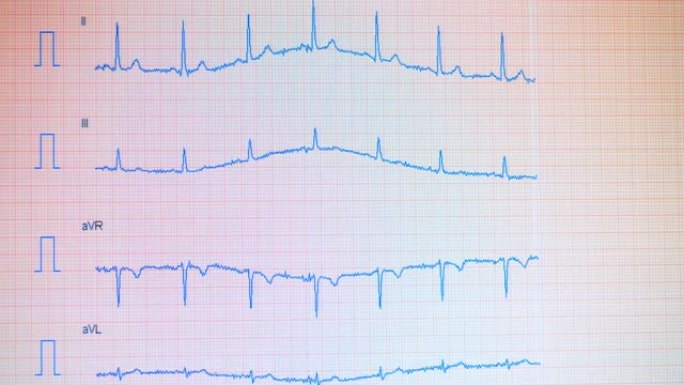 在屏幕上绘制有心电图曲率的屏幕。心脏脉搏线。