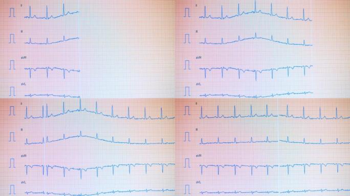 在屏幕上绘制有心电图曲率的屏幕。心脏脉搏线。