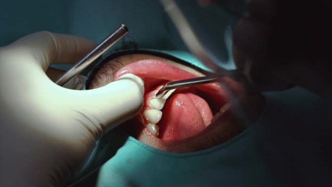 牙科诊所的牙医检查和牙齿清洁和抛光男性患者的4k慢动作镜头特写，牙齿护理和牙齿检查概念