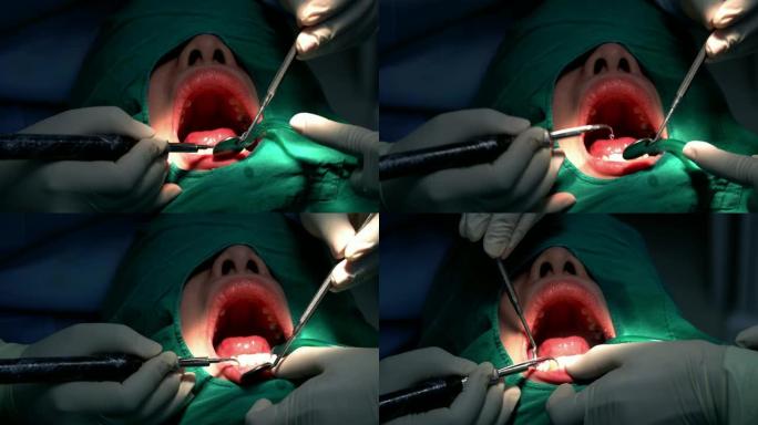 4k镜头场景牙医和助理的特写镜头，为牙科诊所的女性患者进行检查和牙齿清洁和抛光，牙齿护理和牙齿检查概