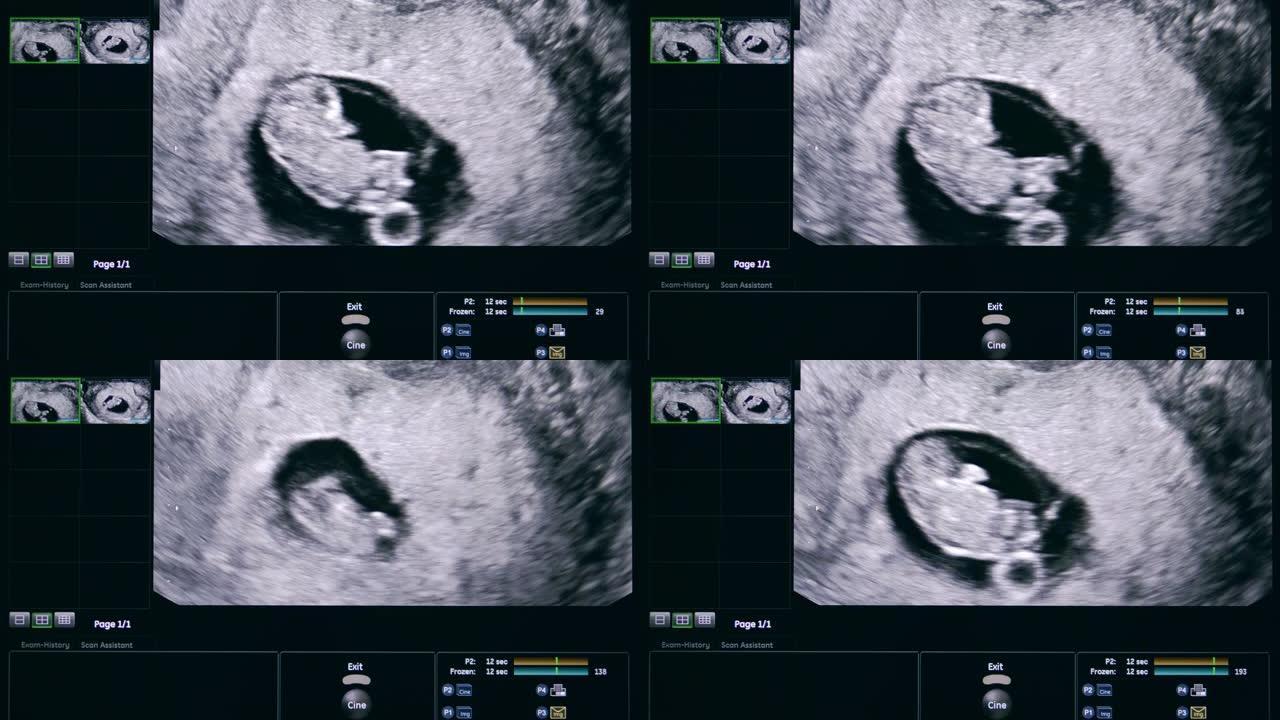 超声波图像上未出生的婴儿