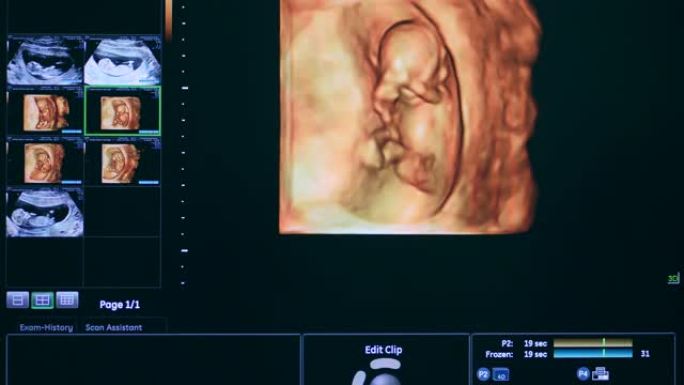子宫内婴儿的超声检查。