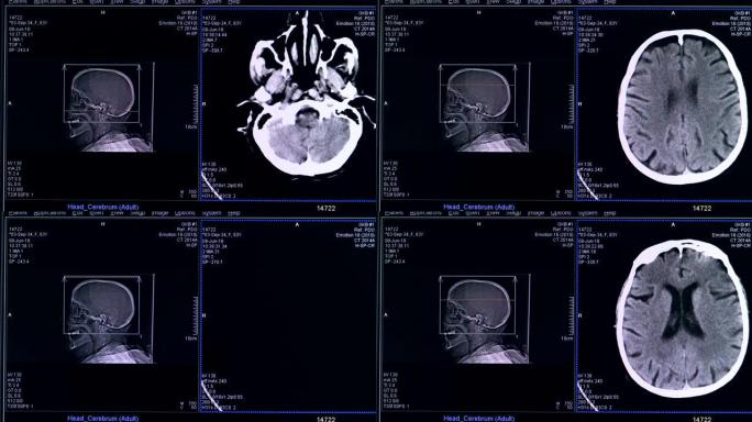 人脑被扫描的实时图像