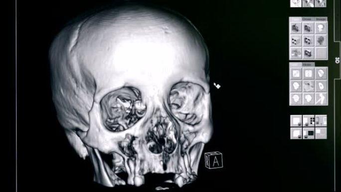 头骨的3D模型，特写。医院设备制作一个人头骨的3D模型。