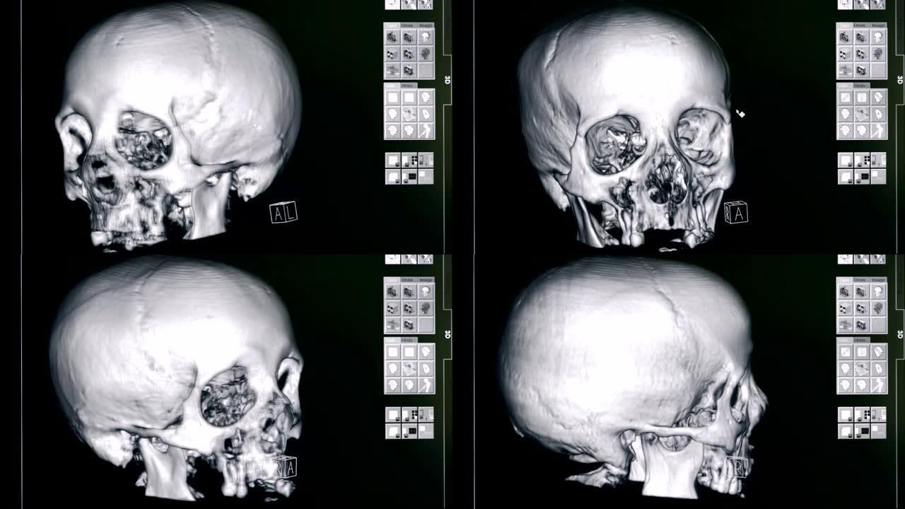 头骨的3D模型，特写。医院设备制作一个人头骨的3D模型。