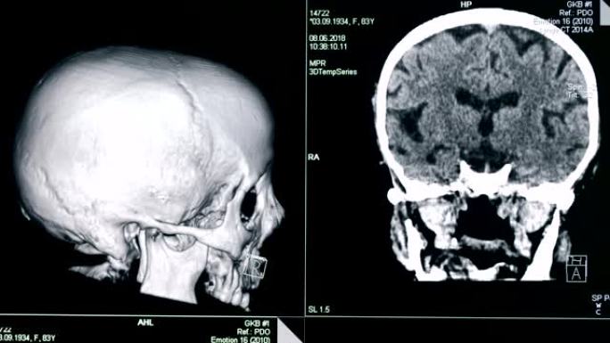 头骨模型在屏幕上旋转，特写。医疗机器创建病人头骨的模型。