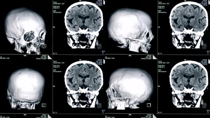 头骨模型在屏幕上旋转，特写。医疗机器创建病人头骨的模型。
