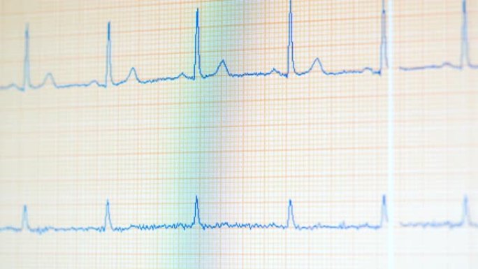 带有不断变化的EKG读数的医疗监视器。心电监护仪显示健康的心跳。