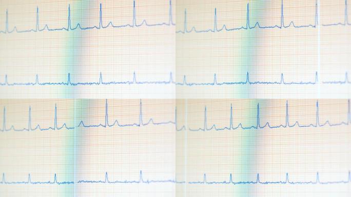 带有不断变化的EKG读数的医疗监视器。心电监护仪显示健康的心跳。