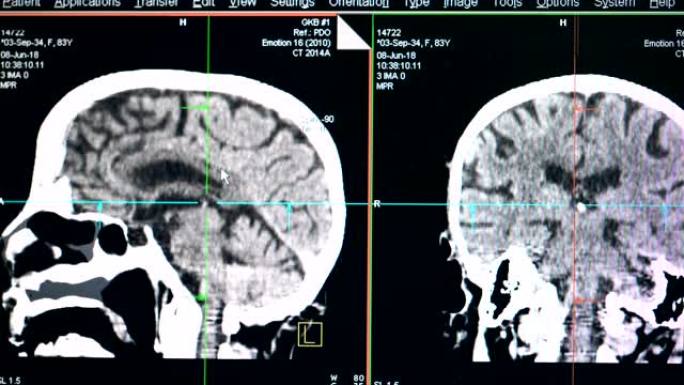 大脑扫描的照片，特写。