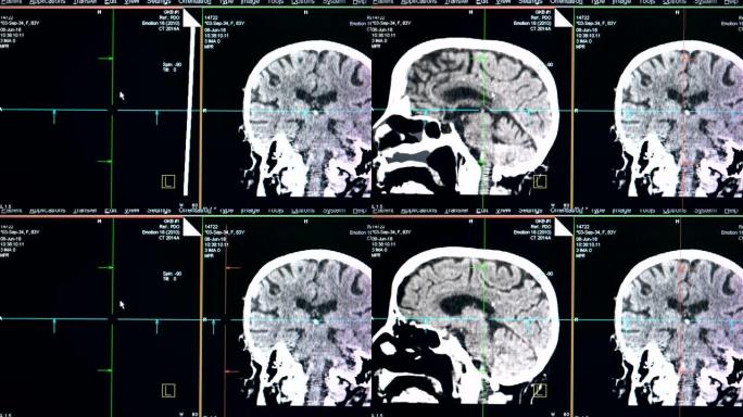 大脑扫描的照片，特写。