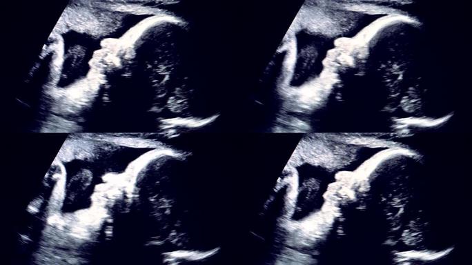 超声期间胎儿的黑白实时照片