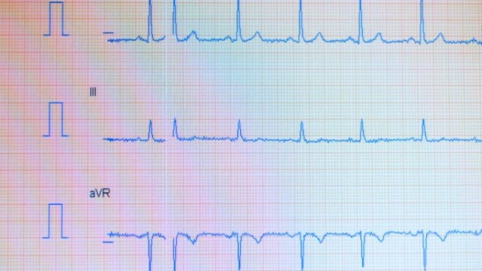 心脏脉搏线。心电图过程显示在屏幕上。