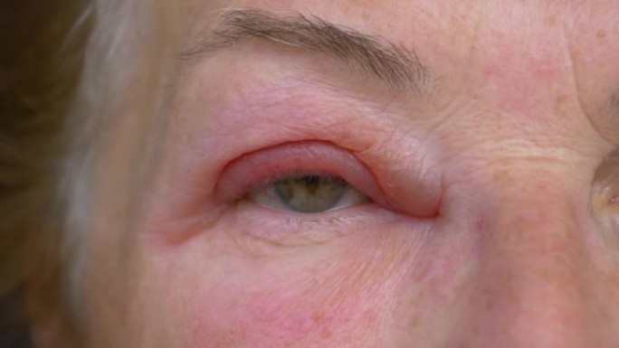 特写镜头，dop: 一名衰老的白人妇女发痒的眼睛肿胀的详细照片。